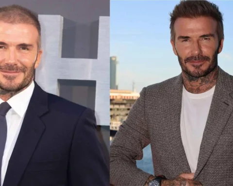 david beckham before and after hair transplant