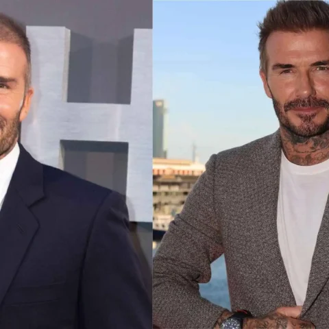 david beckham before and after hair transplant