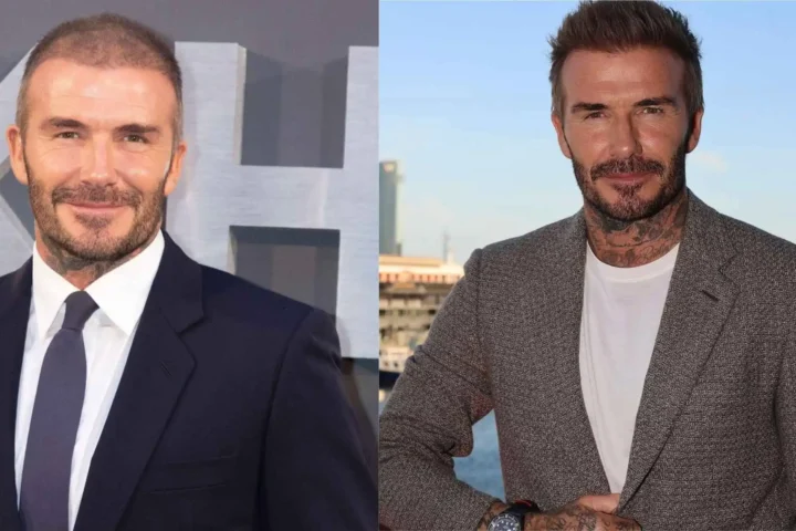 david beckham before and after hair transplant