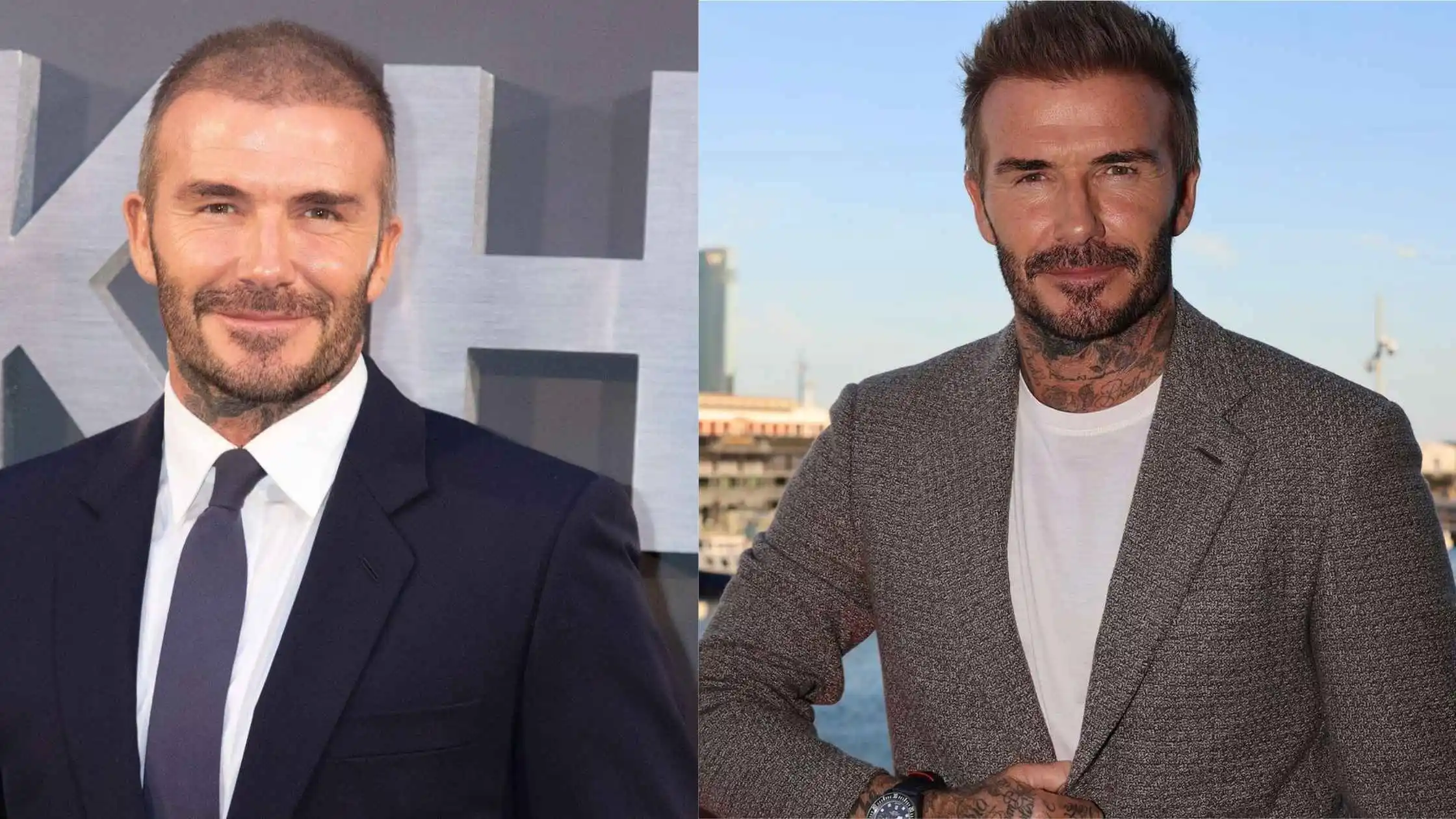 david beckham before and after hair transplant