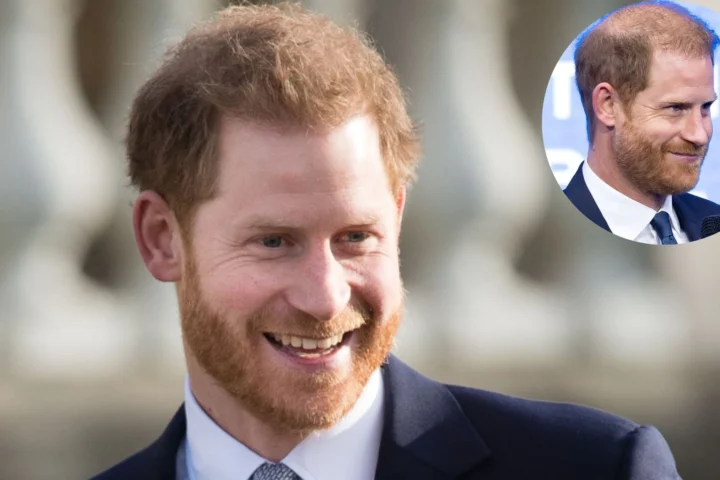 prince harry bald