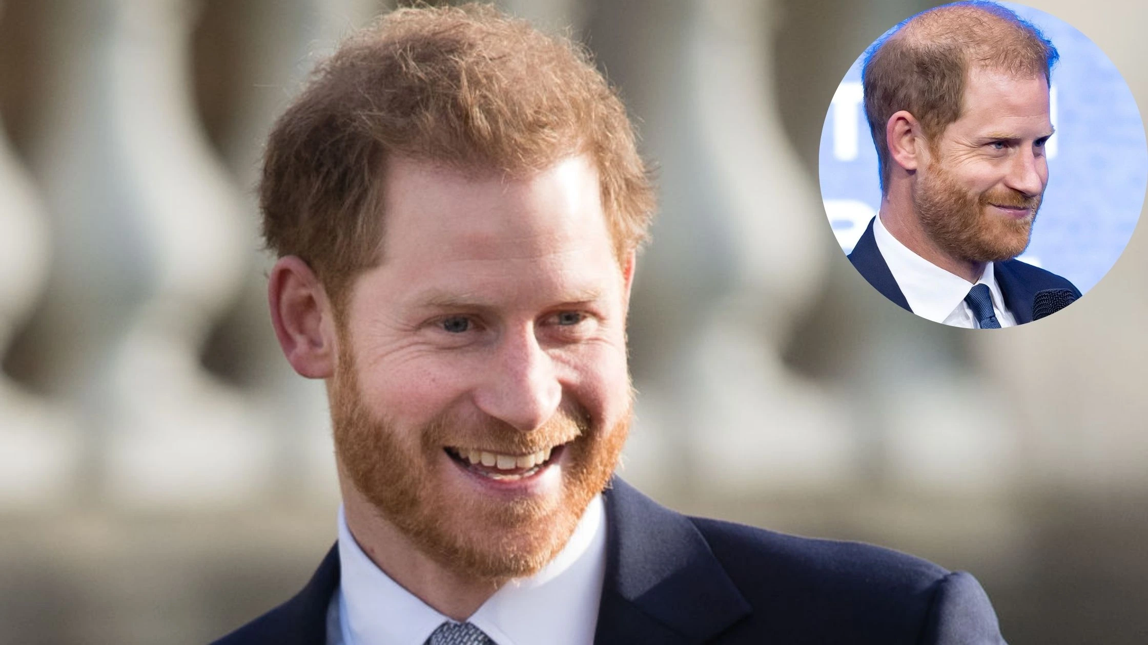 prince harry bald